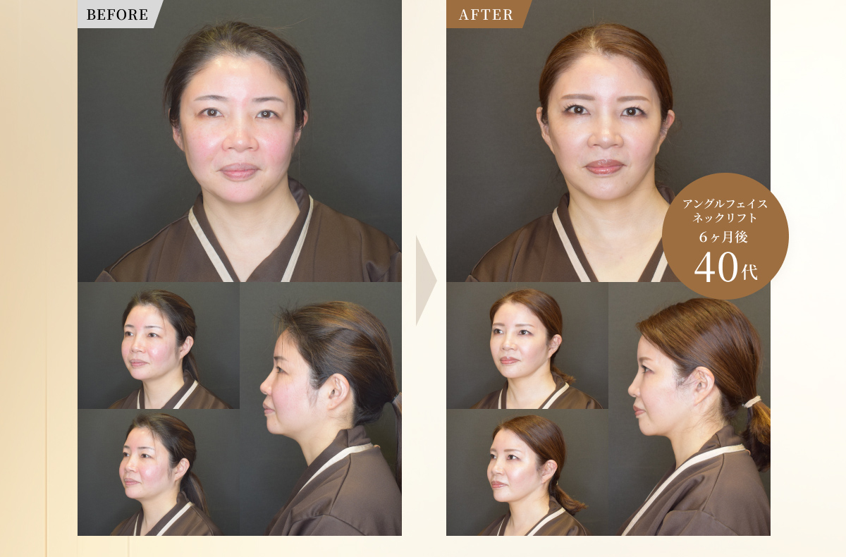 アングルフェイスネックリフト