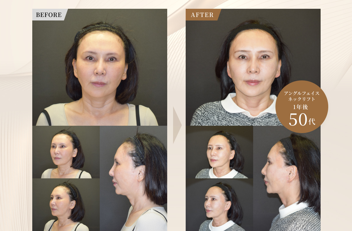 アングルフェイスネックリフト